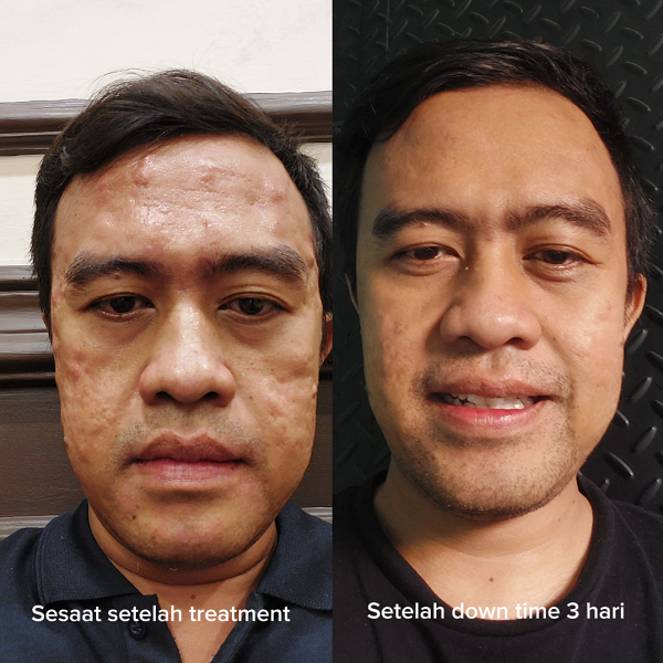 hasil treatment di menology by ZAP